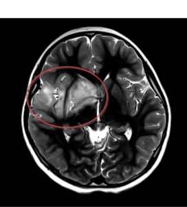Расшифровка МРТ: Ключевые аспекты и преимущества этапа интерпретации