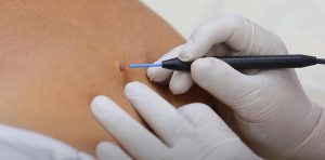 Безболезненное избавление от бородавок: современные методы и технологии