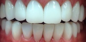 Преимущества циркониевых коронок: Золотой стандарт стоматологии