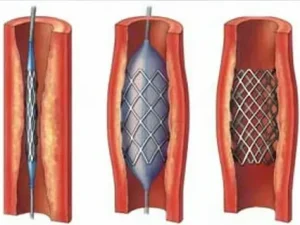 Стентирование: Что это и для чего оно необходимо