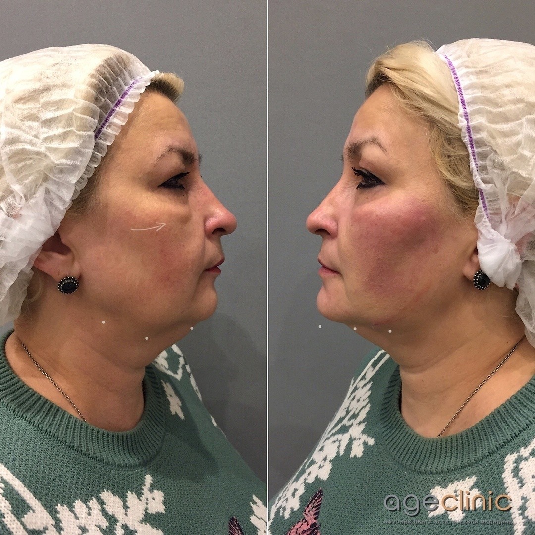 Инъекционная косметология: Современные методы омоложения и коррекции