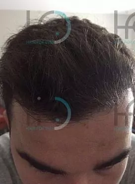 Пересадка волос для мужчин: новые горизонты в борьбе с облысением